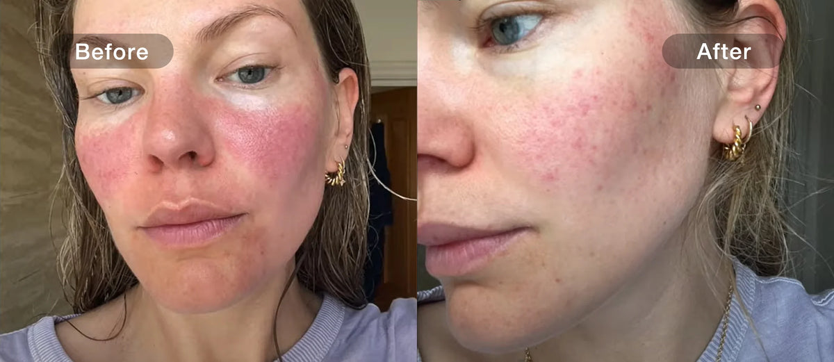 Redness before and after comparison
